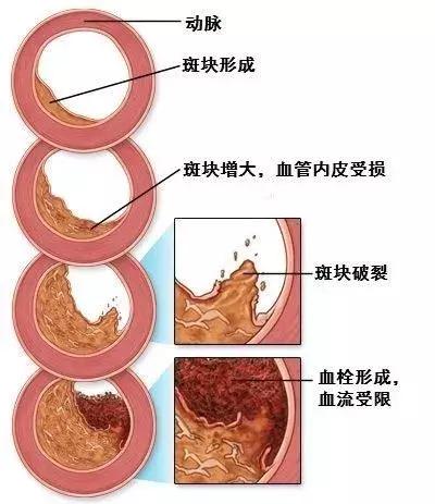 心脑血管疾病：比癌症更加威胁中国人健康~